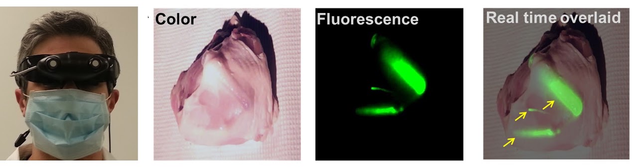 A photo of a person wearing smart goggles followed by images showing color, fluorescence, and real-time overlay of fluorescence on color